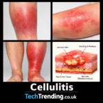 Cellulitis